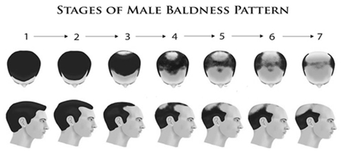 What is Baldness- its Causes & Treatments?